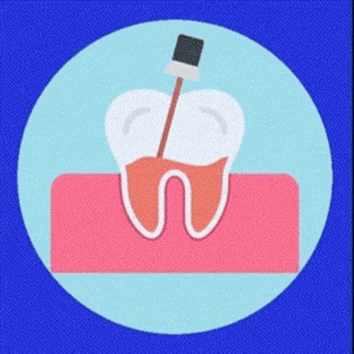 Root Canal